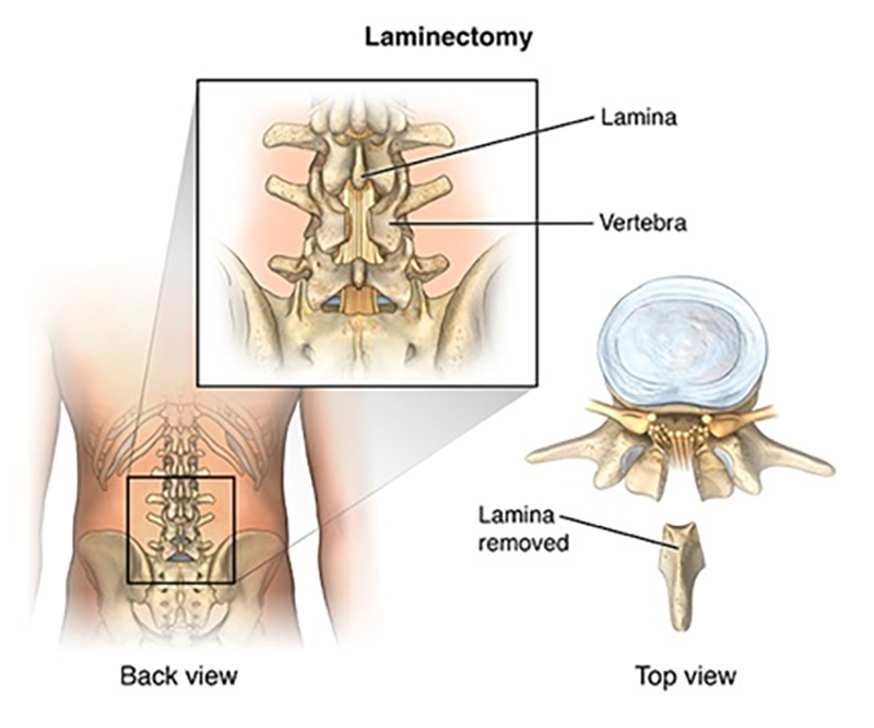 Laminektomi nedir?